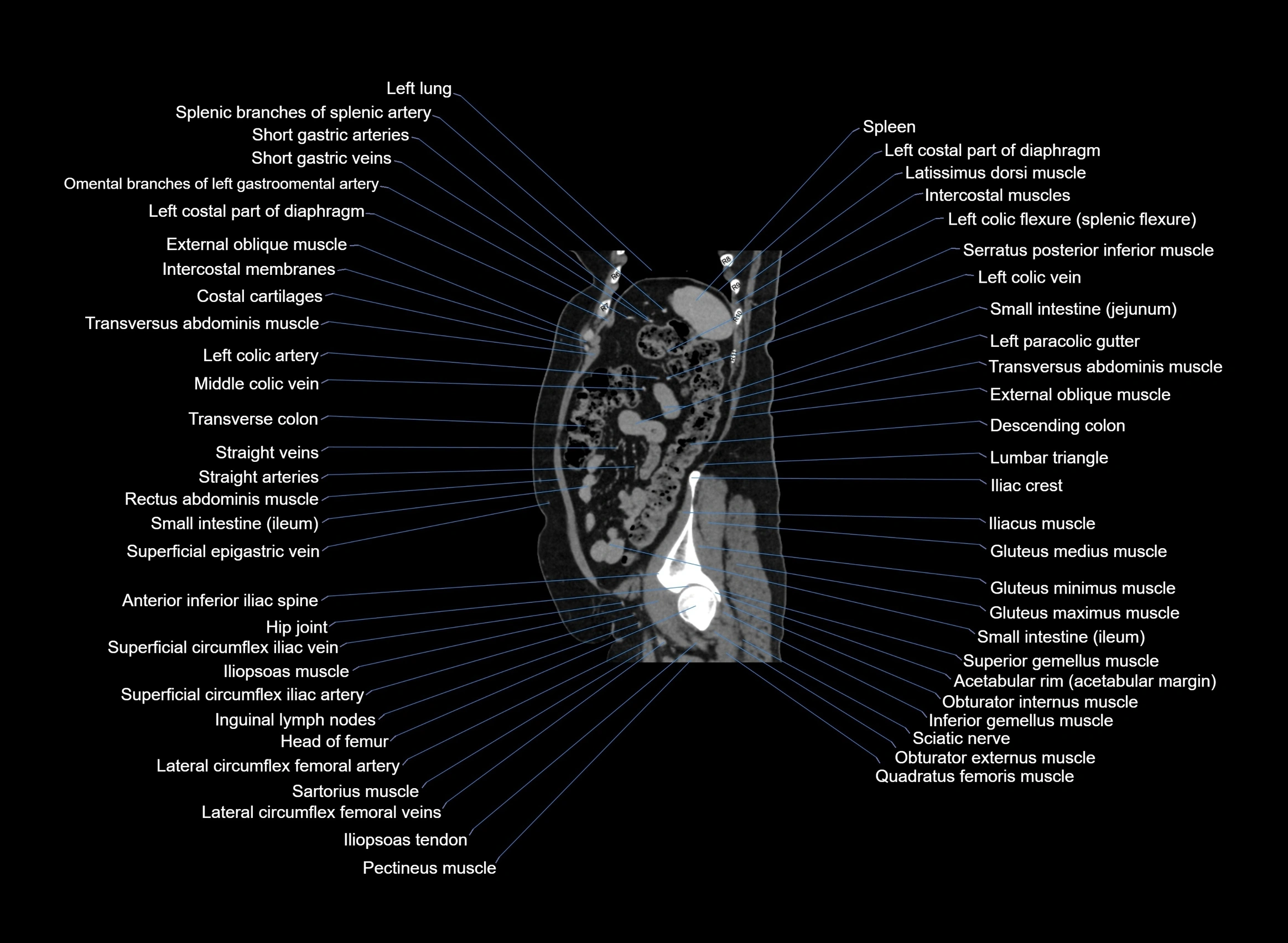 CT Abdomen sagittal cross sectional anatomy labelled radiology image -00026.webp